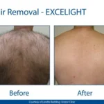 Hair Removal