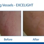 Red Vein Removal