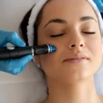 Micro dermabrasion 