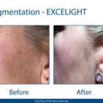Pigment Removal