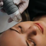 Radio Frequency Facelift 